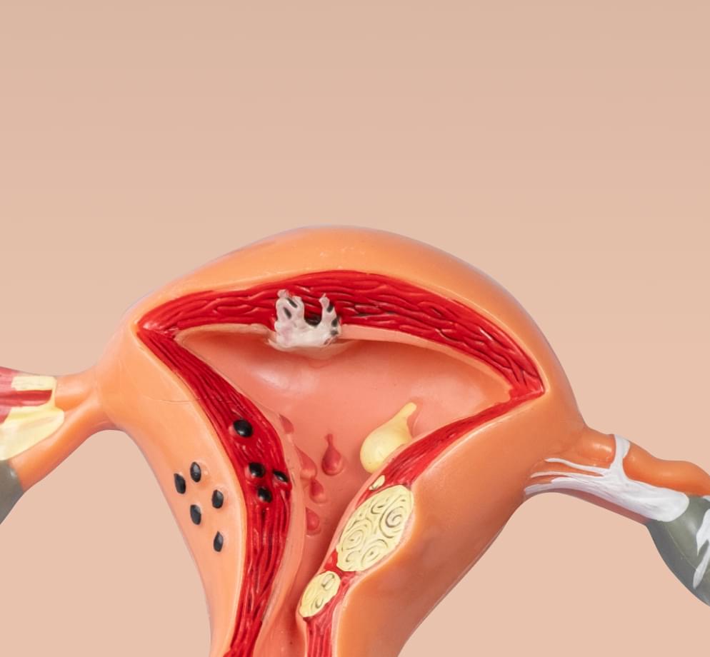 Картинка с визуализацией кисты яичников